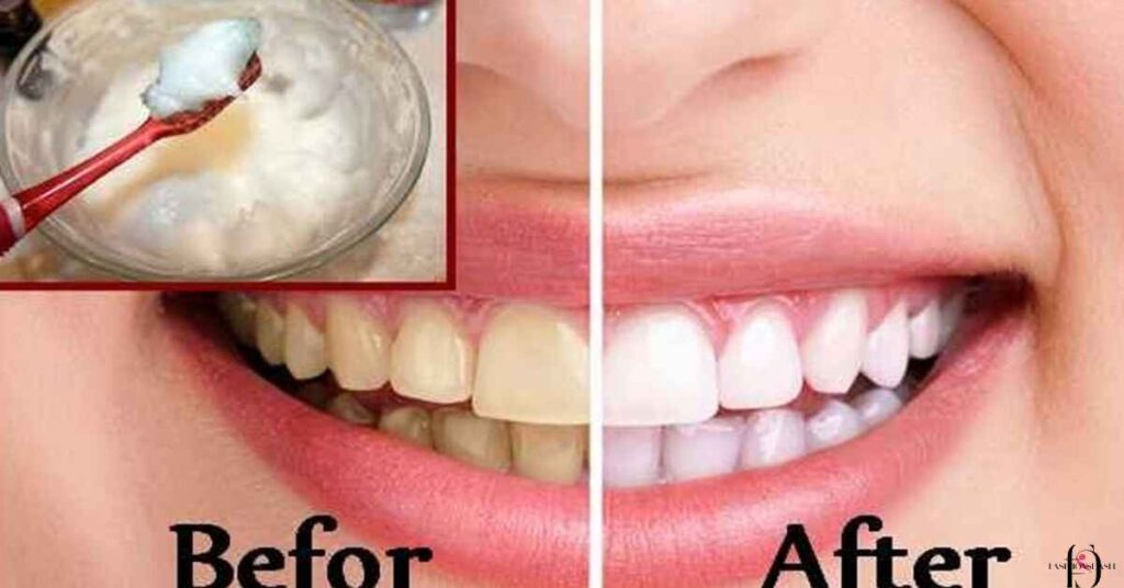 How To Remove Calcium Deposits On Teeth At Home