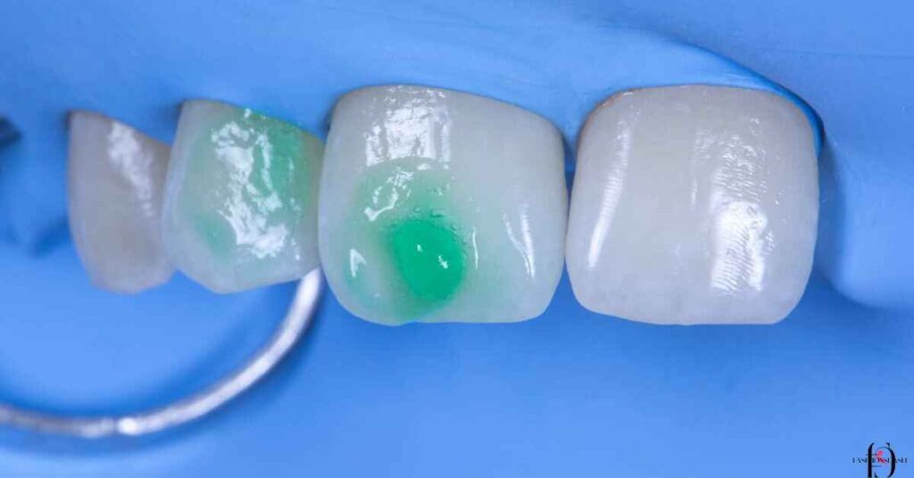 What Causes Hypo plastic Teeth?