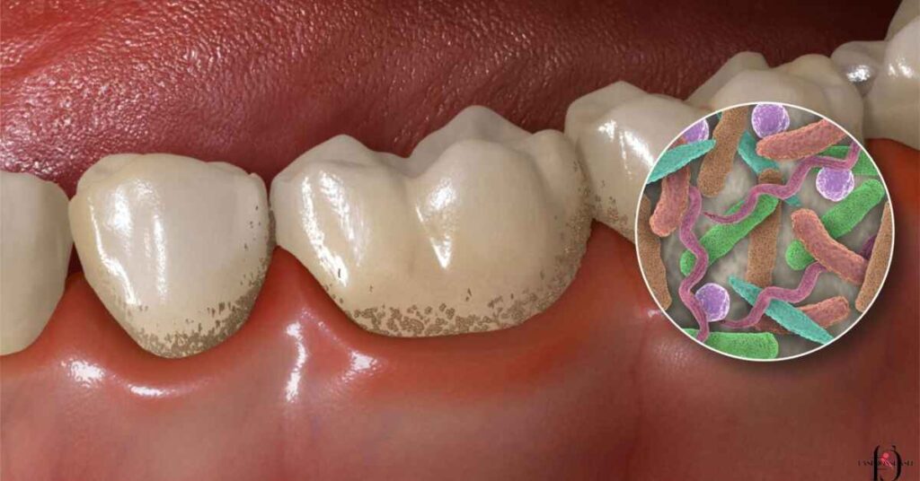 Why Do I Get Calcium Deposits on My Teeth?